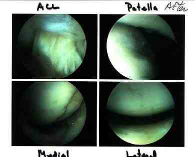 Lyn's right knee through arthroscopic camera. (19KB/72KB)