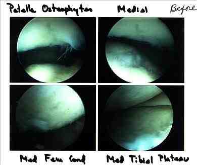 Lyn's right knee through arthroscopic camera. (19KB/68KB)