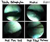 Lyn's right knee through arthroscopic camera. (19KB/68KB)